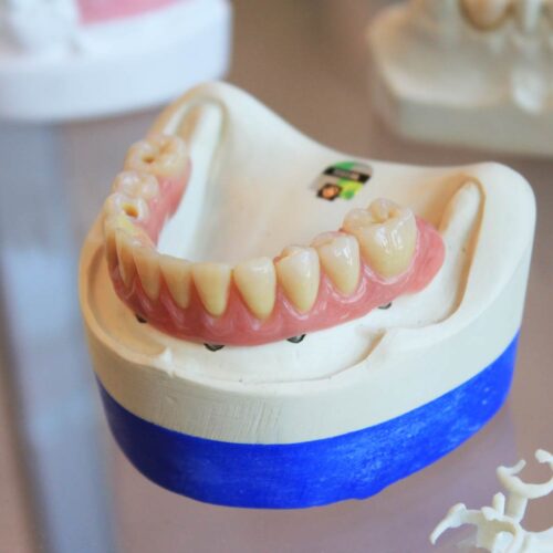 Dental Implants