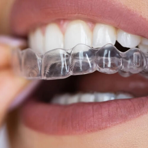 Clean Aligners