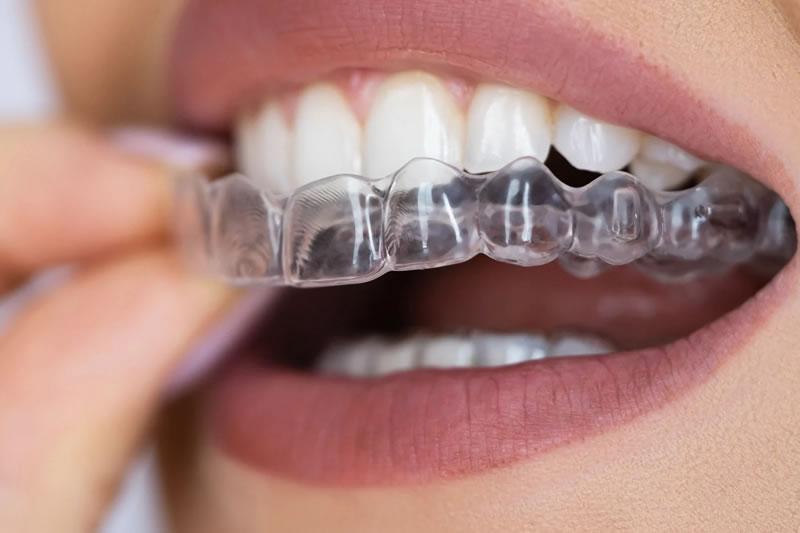 Clean Aligners